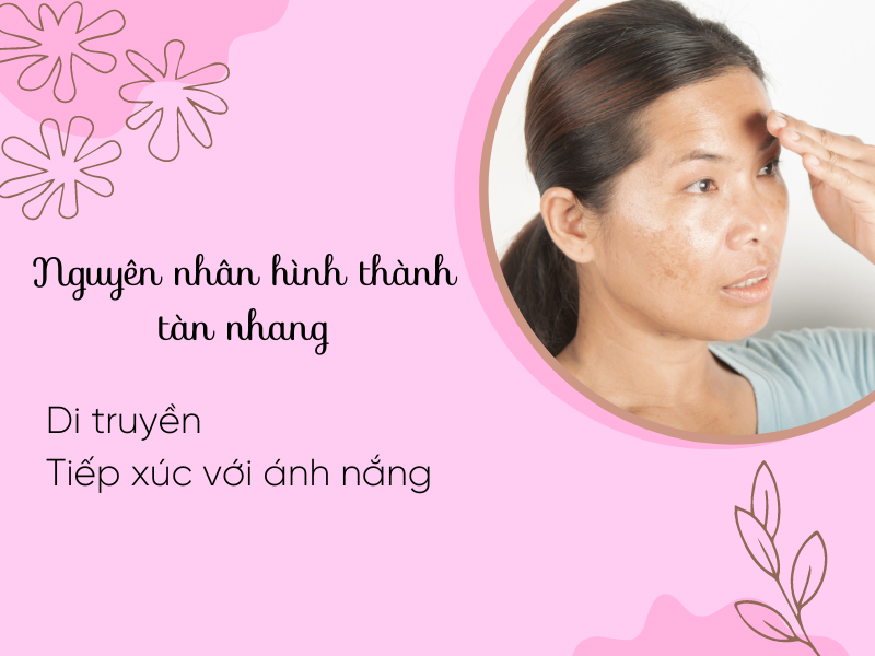 Nguyên nhân hình thành nên tàn nhang, bạn đã biết chưa?